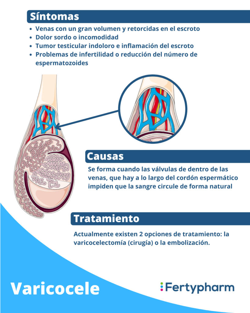 varicocele tratamiento